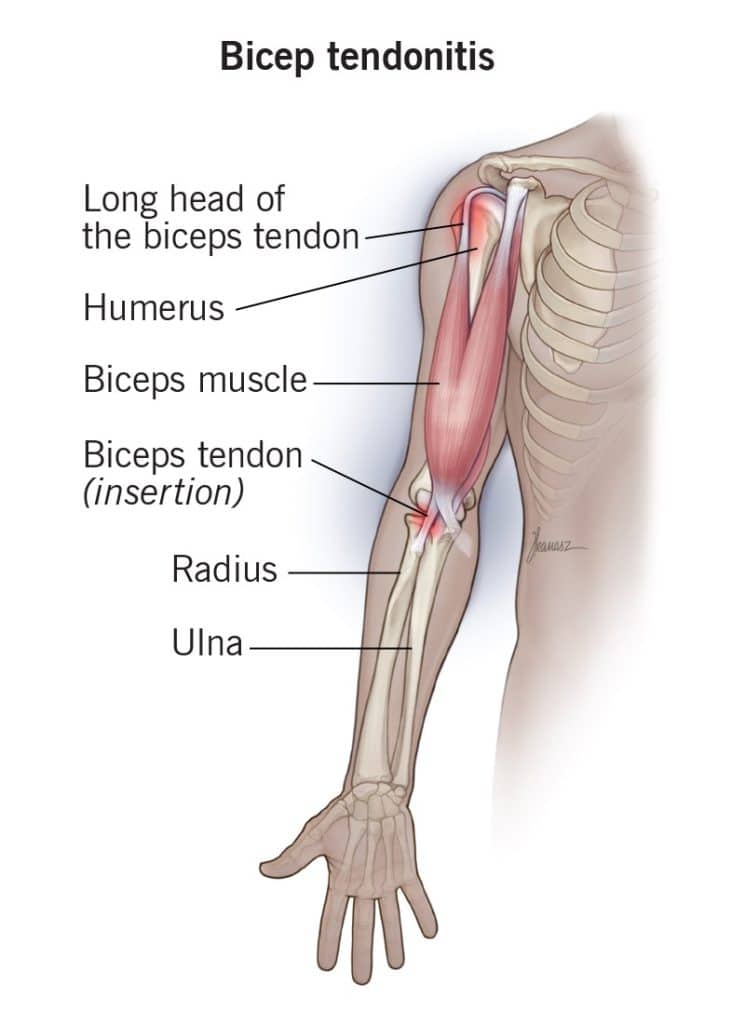 Shoulder Injuries - Bicep Tendonitis