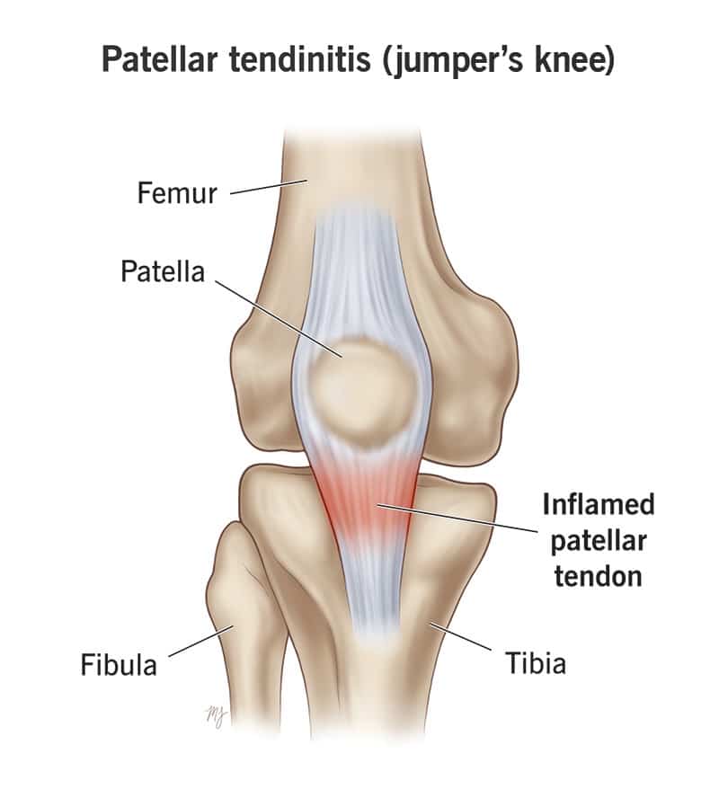 Patellar Tendinitis