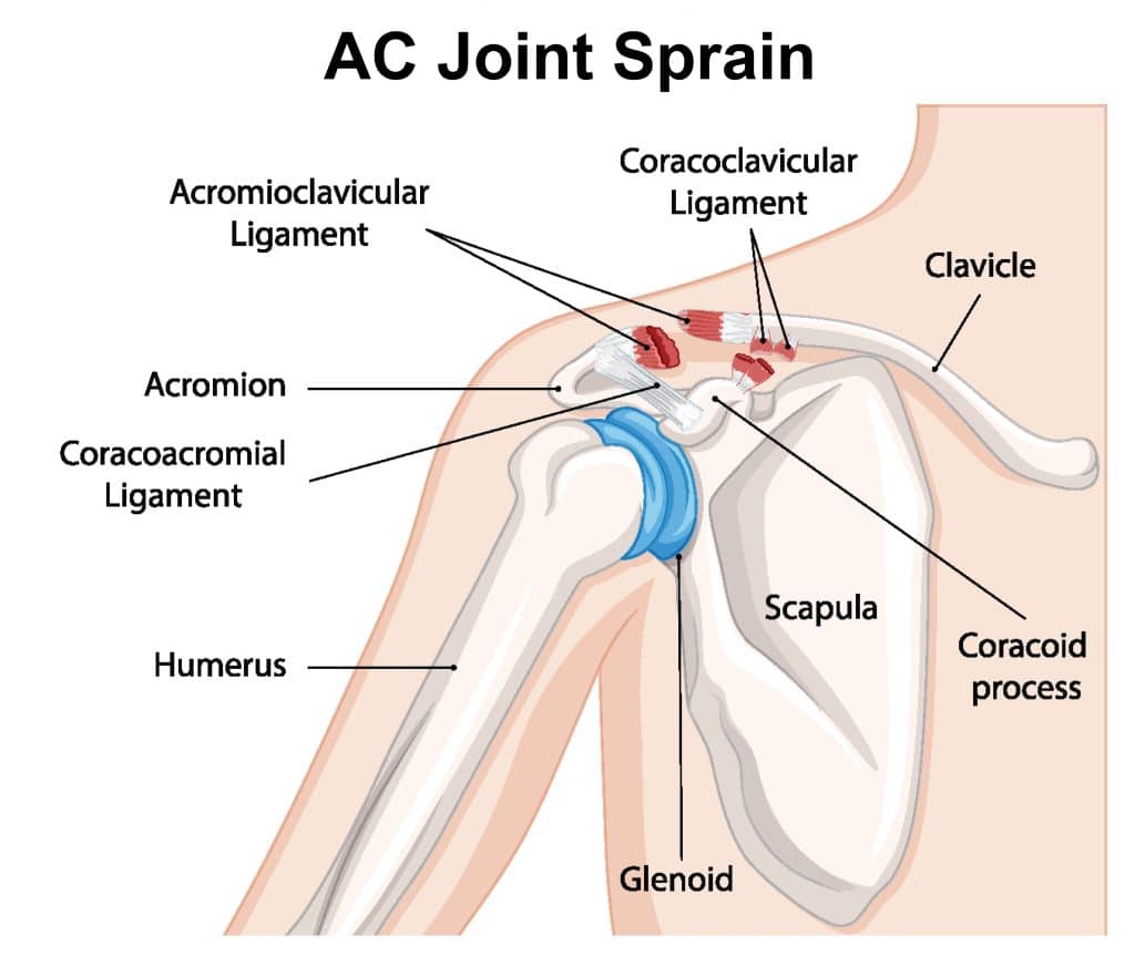 Shoulder Injuries - AC Joint Sprain