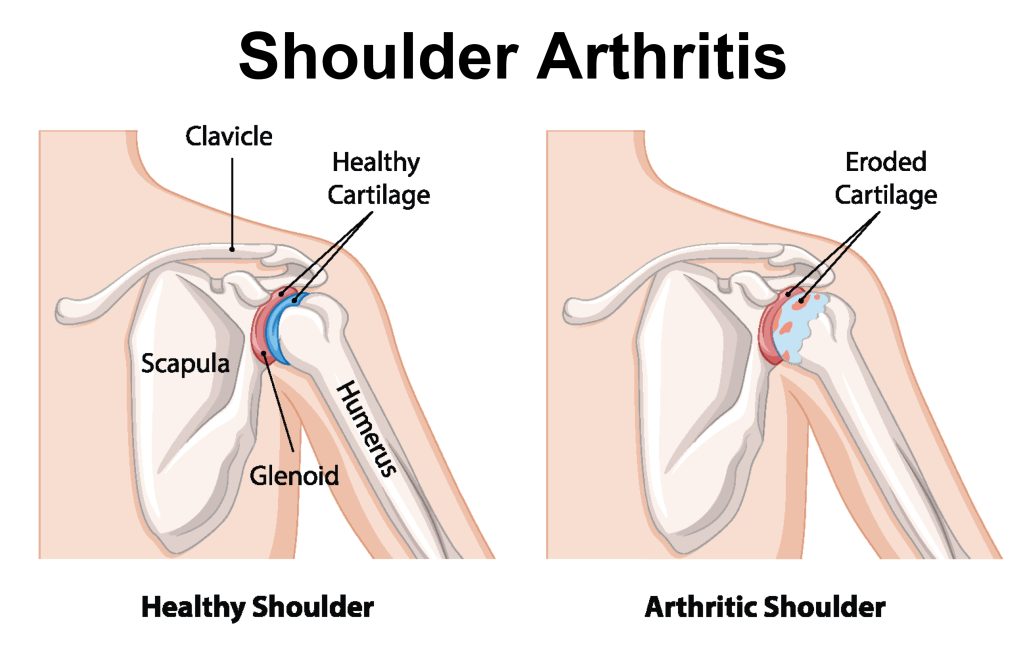 Shoulder Injuries - Shoulder Arthritis