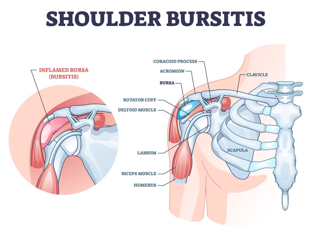 Shoulder Injuries - Shoulder Bursitis