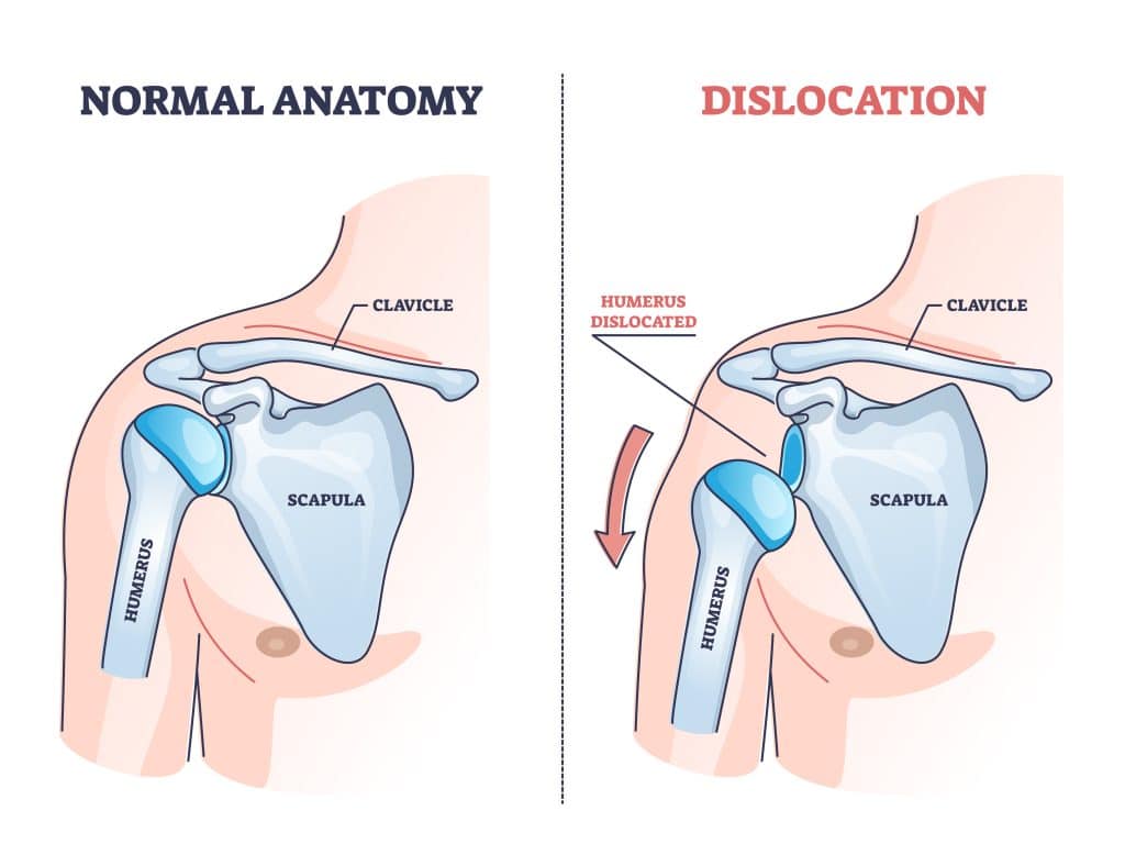 Shoulder Injuries - Shoulder Dislocation