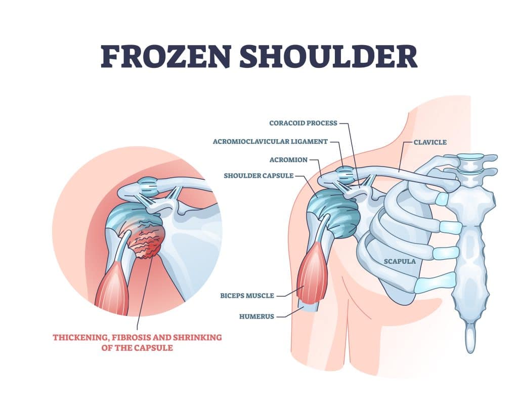 Shoulder Injuries - Frozen Shoulder