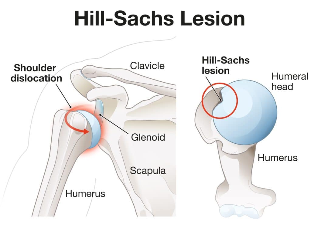 Shoulder Injuries - Hill Sachs Lesion