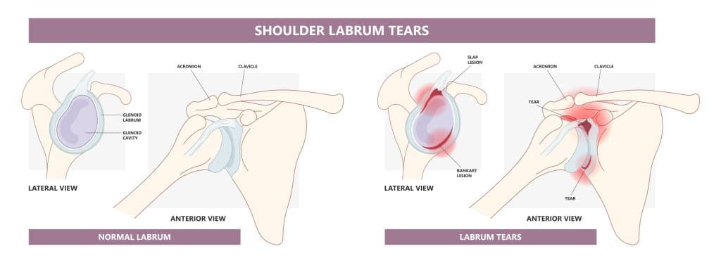 Shoulder Injuries - Labrum Tears