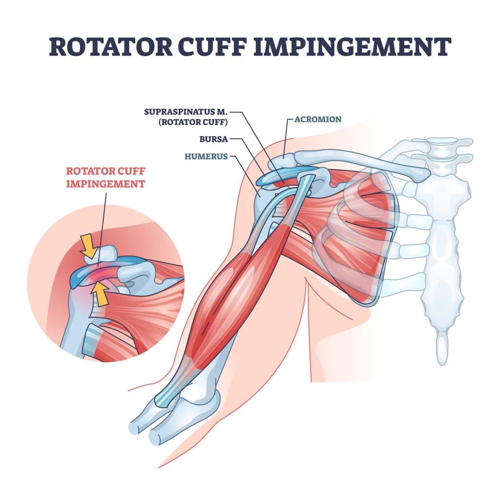 Shoulder Injuries - Rotator Cuff Impingement