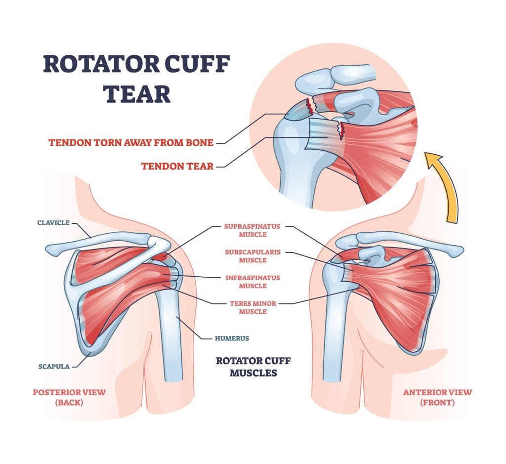 Shoulder Injuries - Rotator Cuff Tears